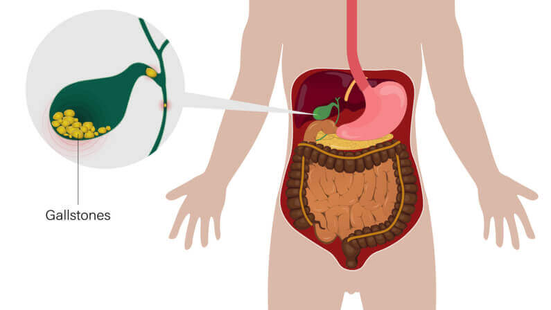 Tips for Maintaining a Healthy Gallbladder