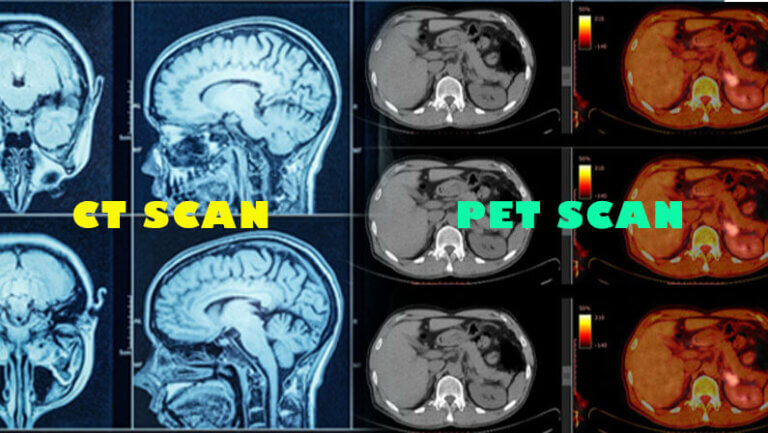 CT scan result and PET scan result