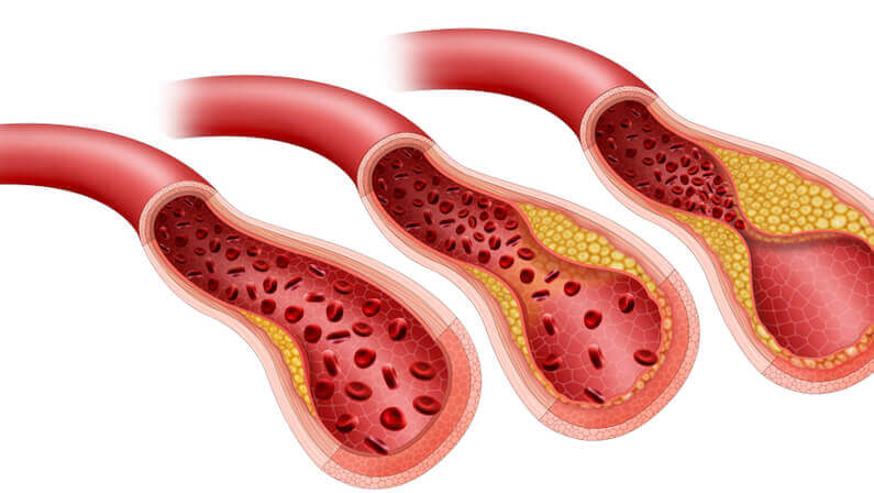Cholesterol build up in the artery