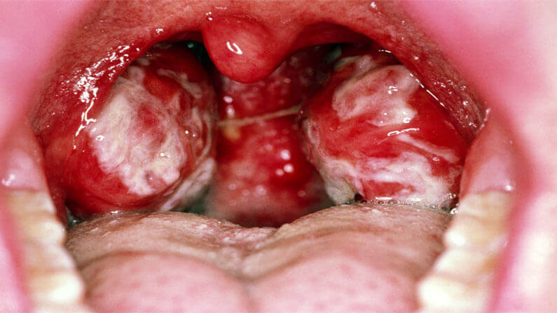 Infectious Mononucleosis throat