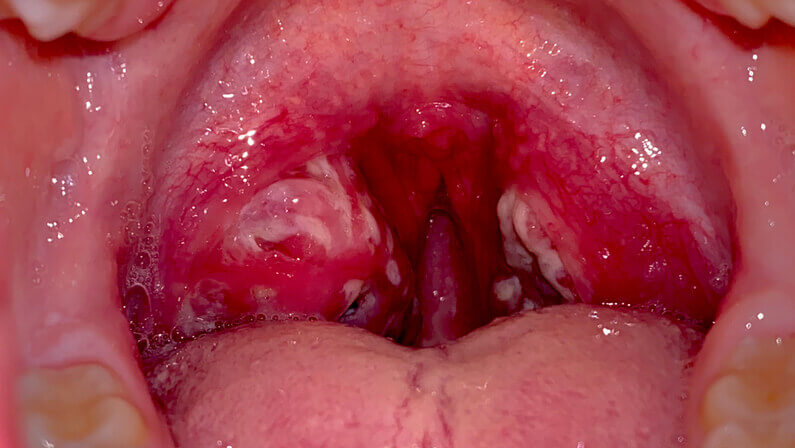 swollen tonsils with white spots and swollen glands