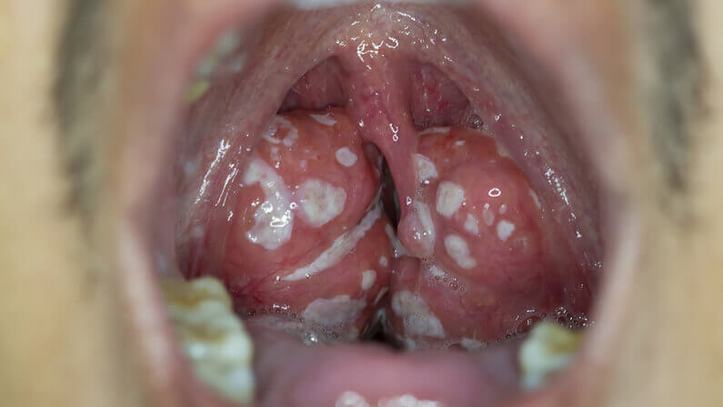 swollen tonsils with white spots and swollen glands