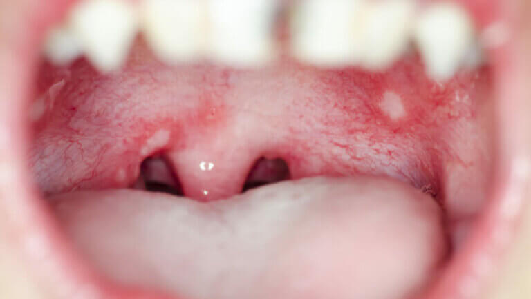 white-spots-on-throat-symptoms