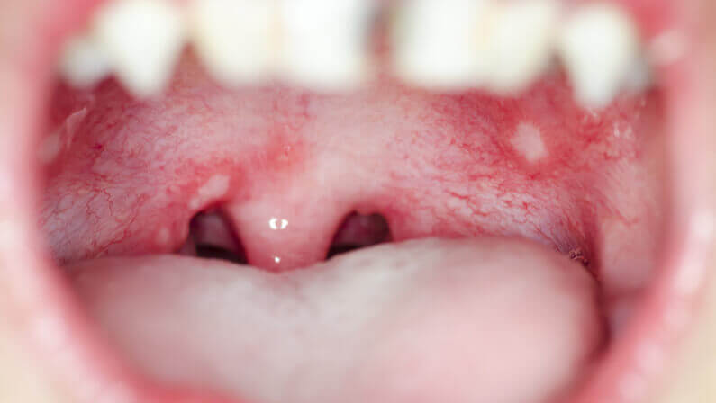 oral thrush close up