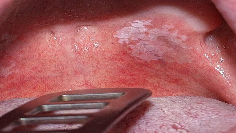 person suffering with Leukoplakia