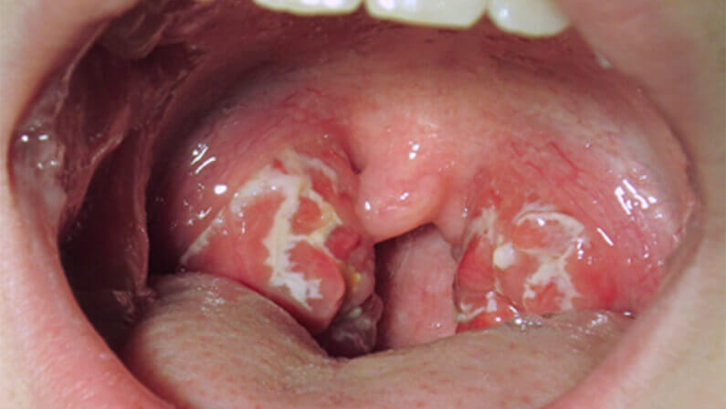 person with strep throat