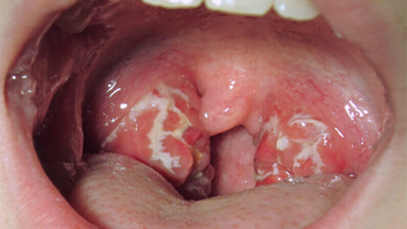 strep throat white spots on tonsils