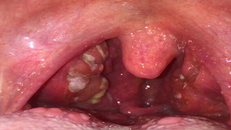 swollen tonsils with white spots and swollen glands