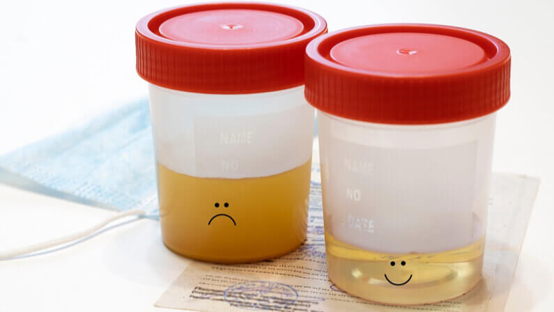 What Does Cloudy Urine Mean? - Aether Health - Kingwood ER