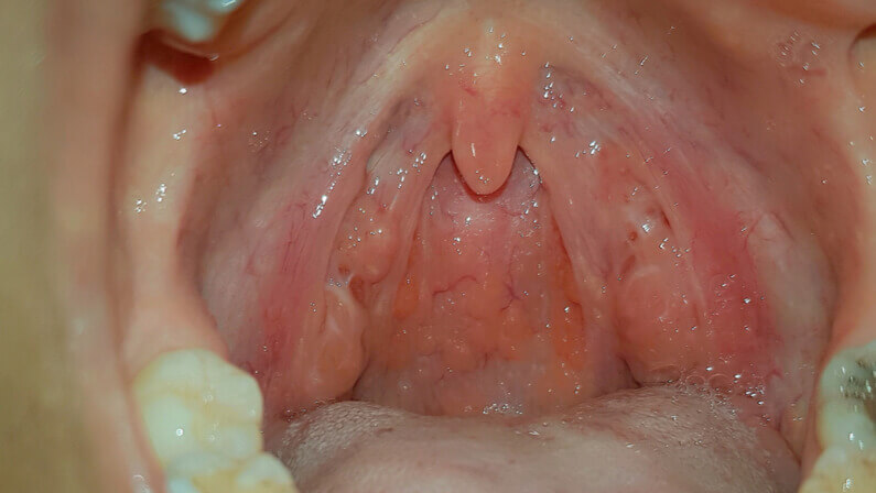 person mouth with Pharyngitis