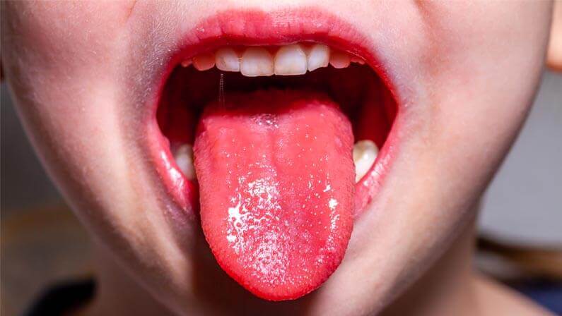 child tongue with scarlet fever
