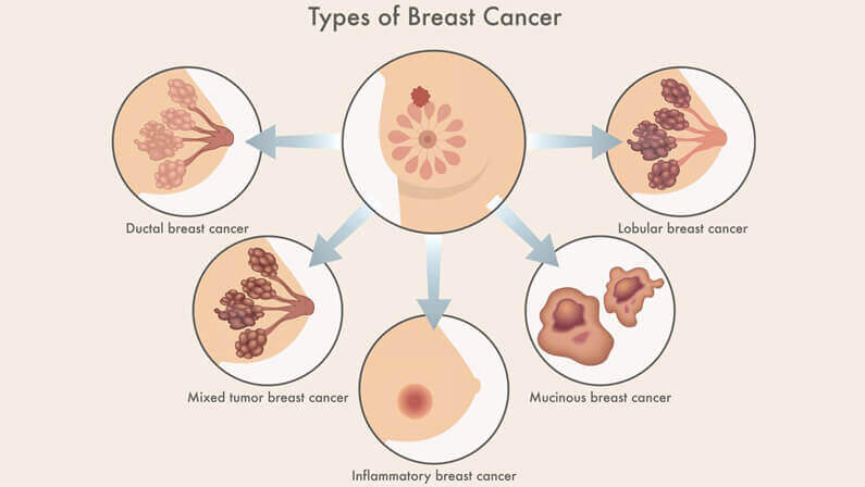 types of breast cancer