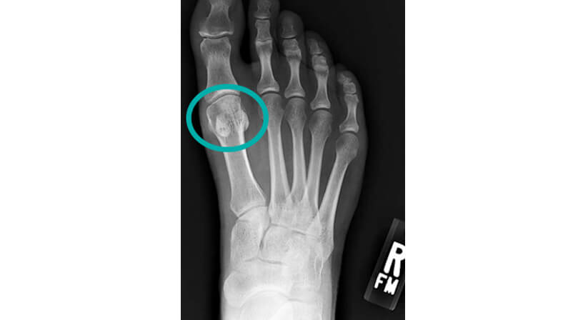 Stress Fracture of the Sesamoids