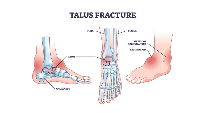 Stress Fracture of the Talus