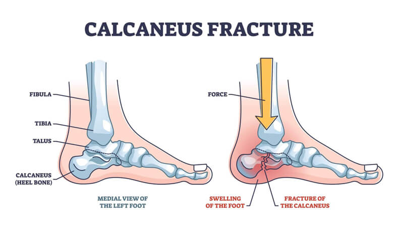 Stress Fractures of the Calcaneus