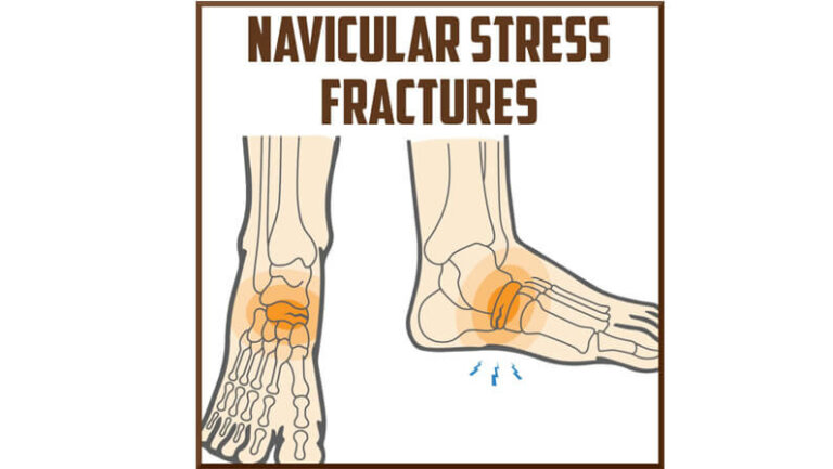 stress-fracture-in-the-foot-causes-and-symptoms