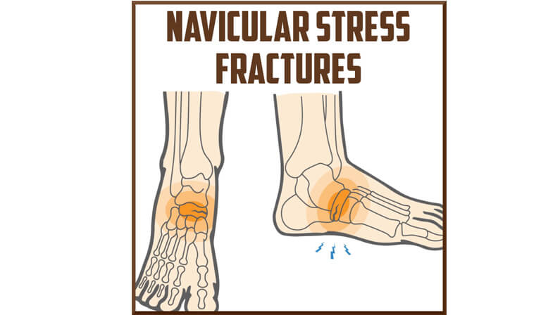 Stress Fractures of the Navicular