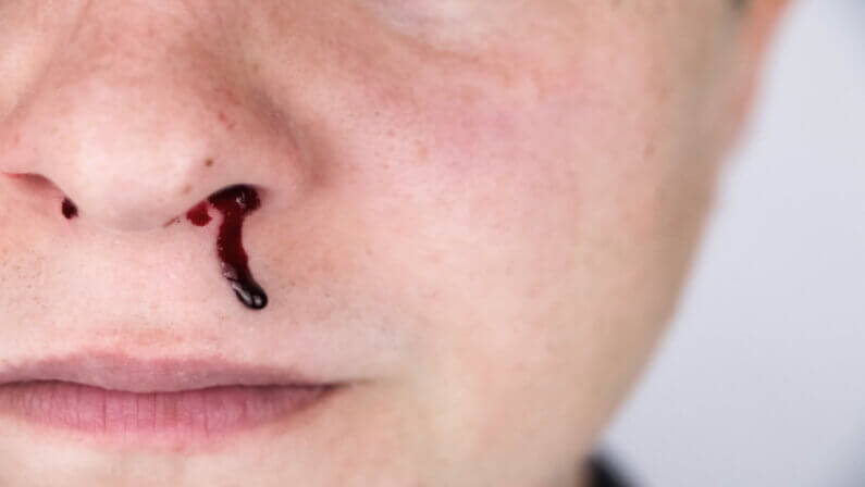 bleeding nose