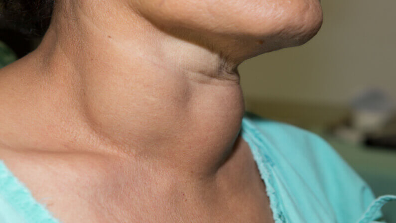 woman with thyroid disease