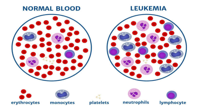 Leukemia blood