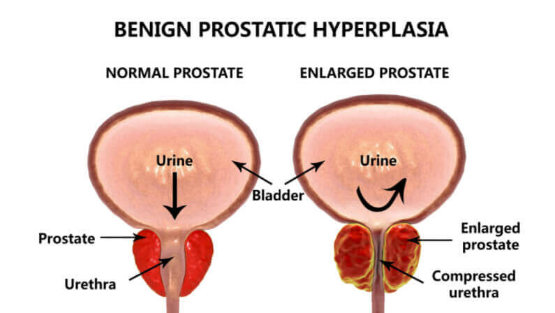 prostatic hyperplasia