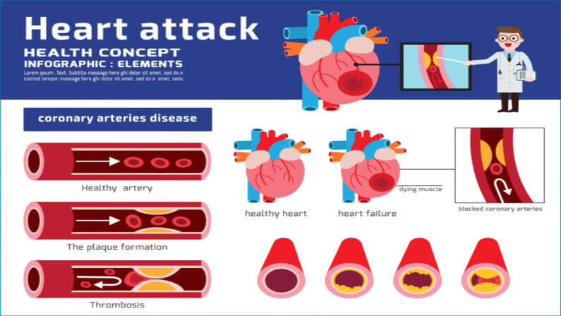heart attack illustration