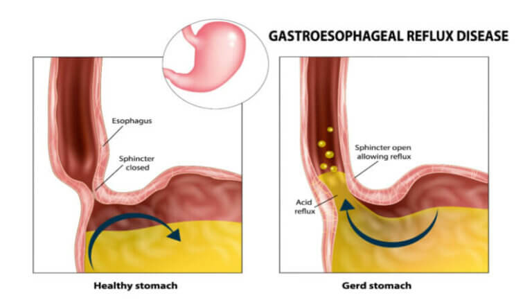 How Long Does GERD Last | Duration, Flare Ups, And Relief Guide