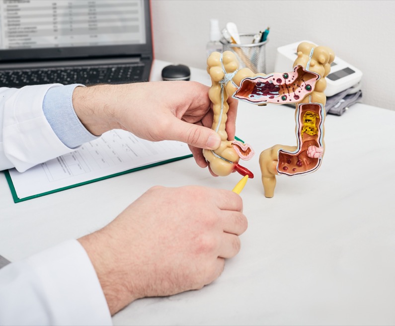 Doctor pointing pen to inflamed appendicitis using a intestines anatomical model.