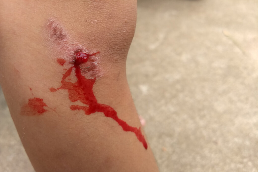 Knee have bleeding wound,wound with scabs on the knee of woman