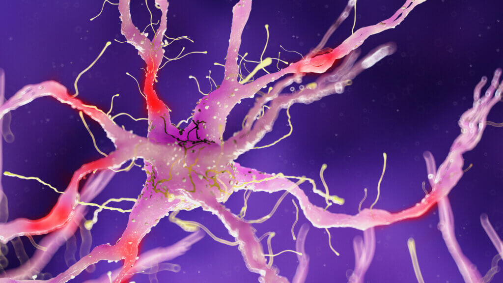 3d rendered medically accurate illustration of a damaged nerve cell