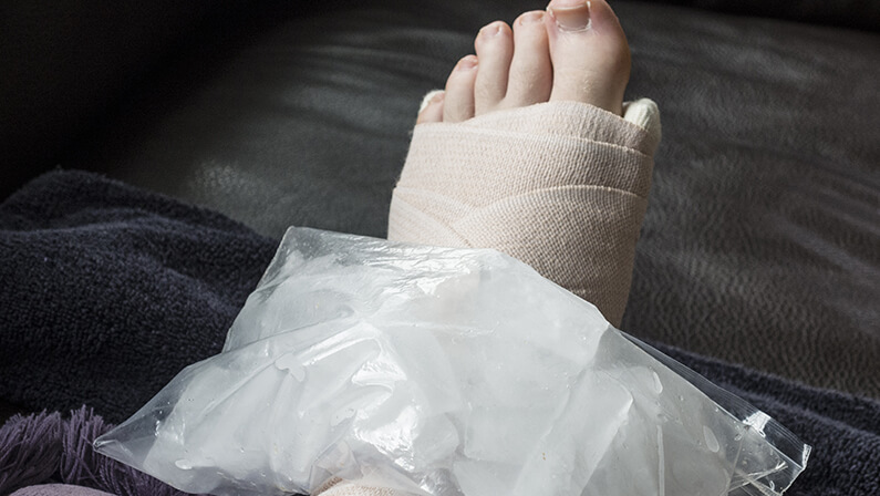 Icing Broken, Fractured or Sprained Foot or Ankle in Cast