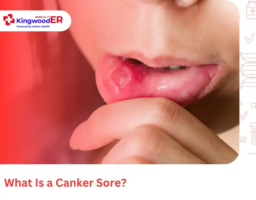 What Is a Canker Sore
