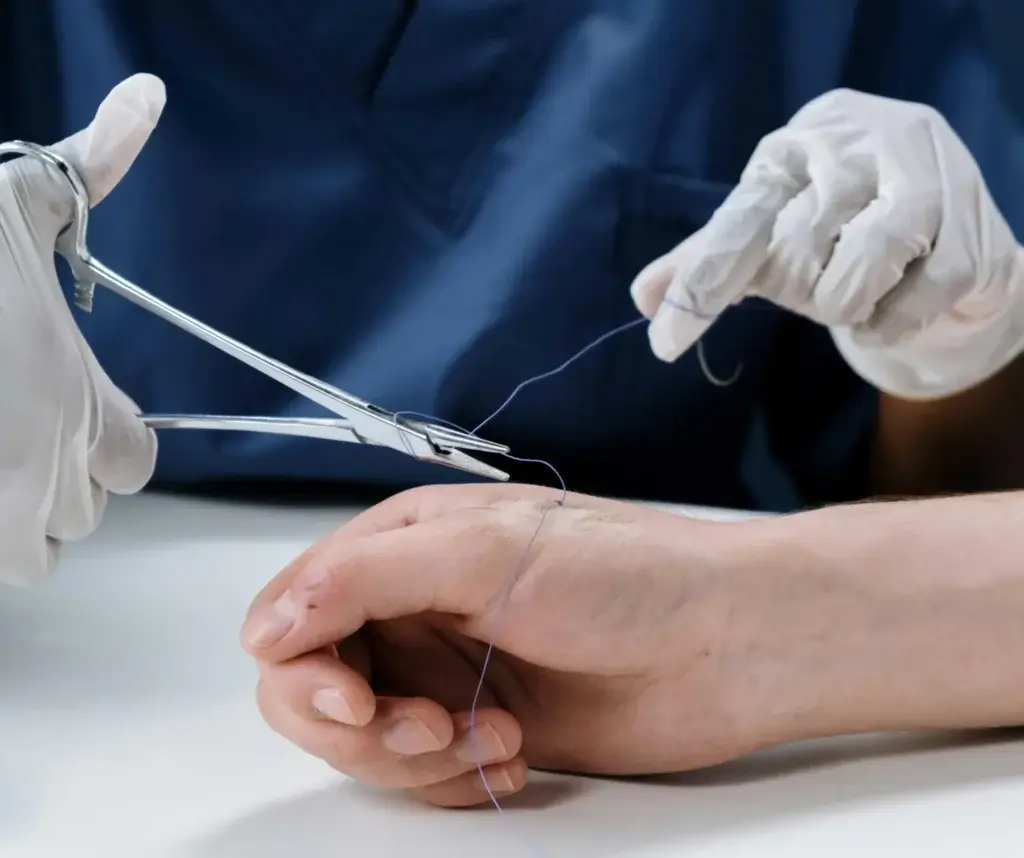 Stitches, Staples, or Surgical Glue