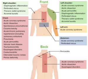 Sore Point Chest Chest Pain Location Chart: What Each Area Tells You