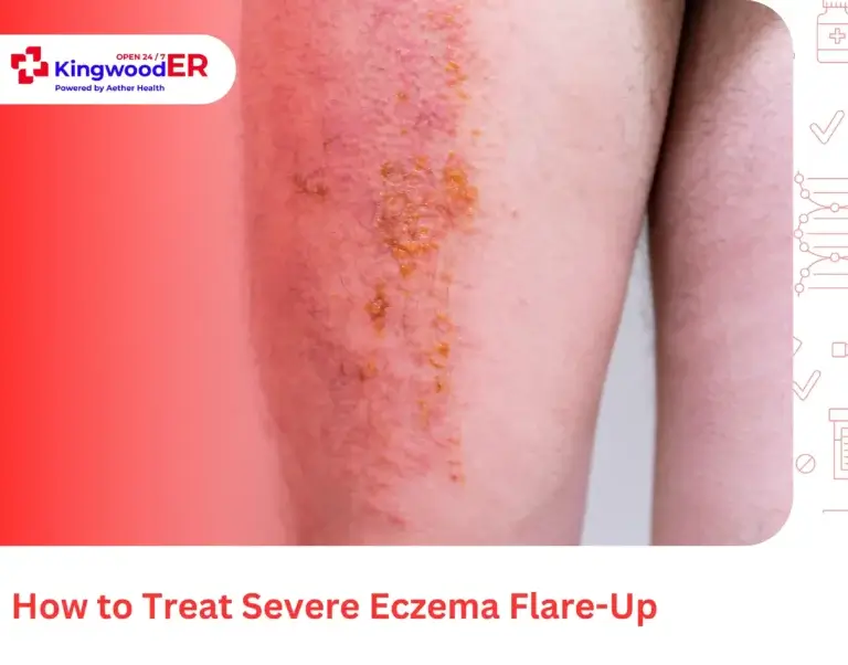 How to Treat Severe Eczema Flare-Up