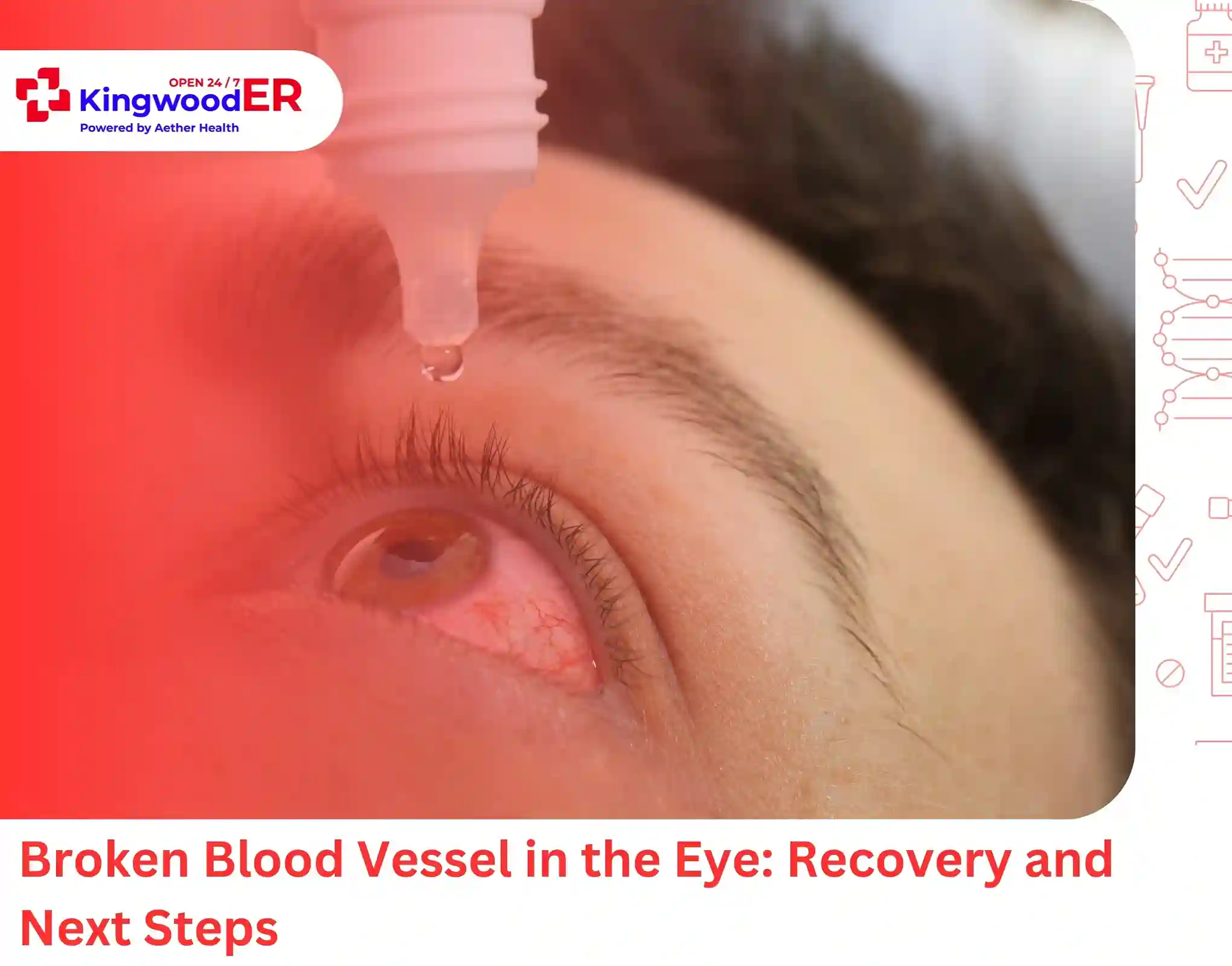 Broken Blood Vessel in the Eye Recovery and Next Steps