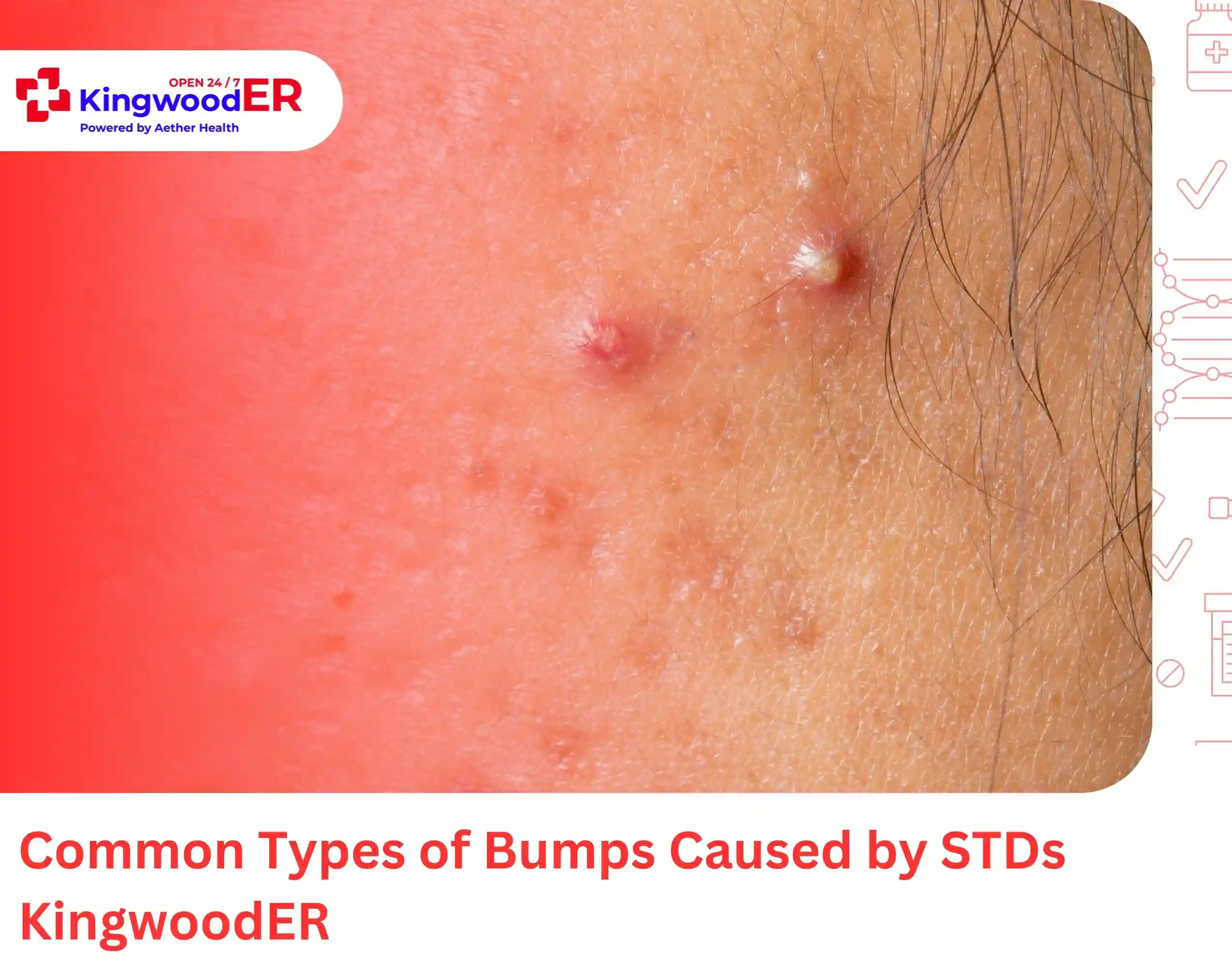Common Types of Bumps Caused by STDs