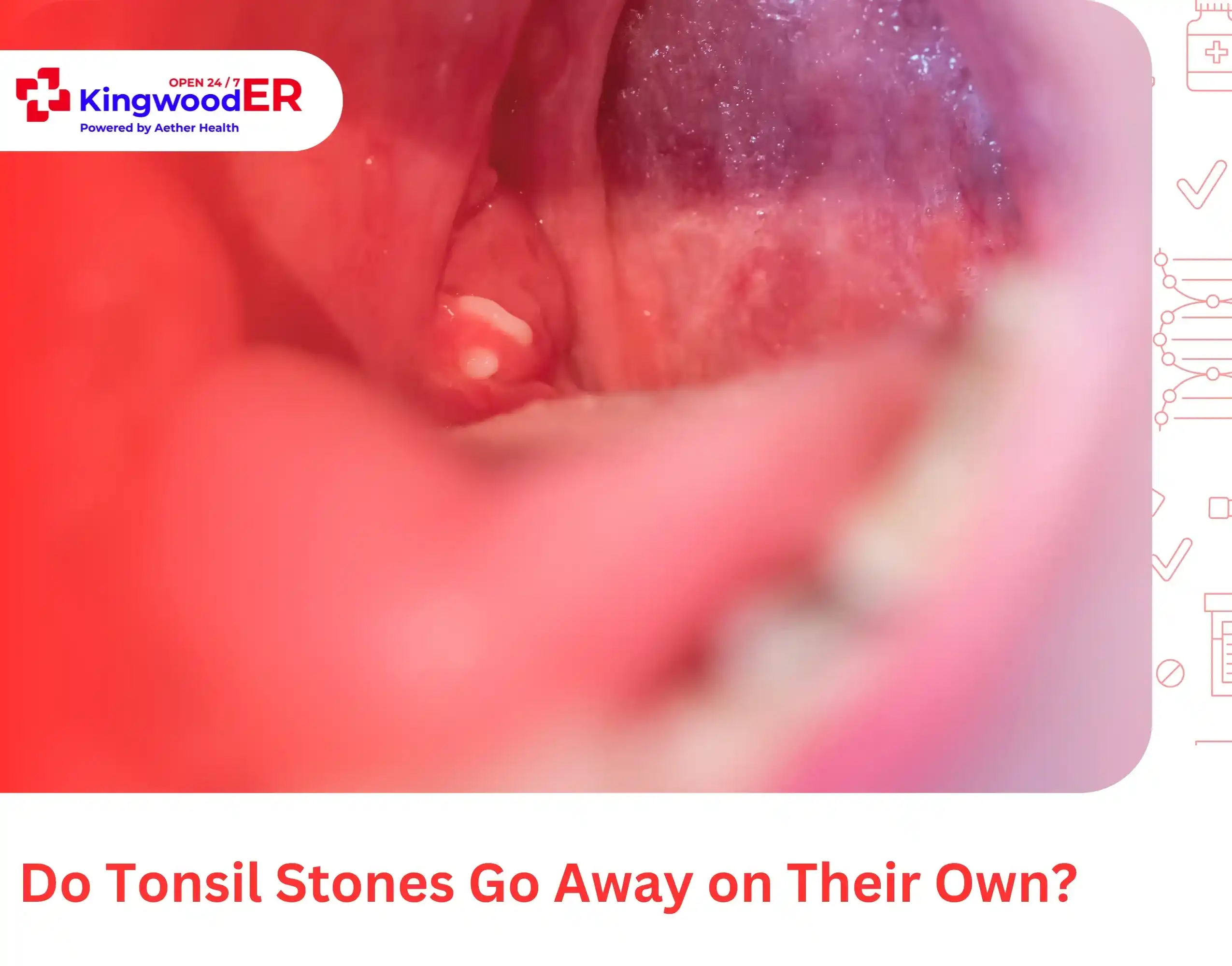 Do Tonsil Stones Go Away on Their Own