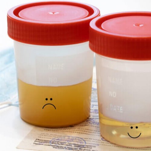 cloudy urine and a clear urine inside a container
