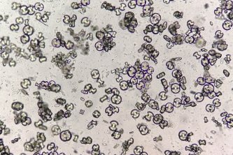 Microscopic image showing calcium oxalate monohydrate, uric acid crystals and triple phosphate crystals from urine sediment. UTI. kidney disease.