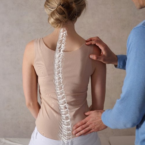 women diagnosed with scoliosis
